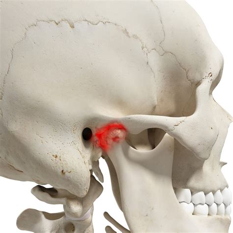 Tac de ATM Articulación Temporomandibular CBCT Radiología Dental