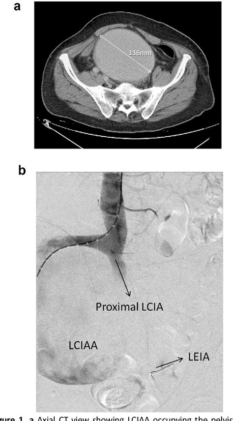 Figure 1 From Ultrasound Assisted On Table Management Of Type III