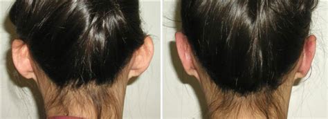 Protruding Ears Gallery Richmond Va Cosmetic Facial Surgery