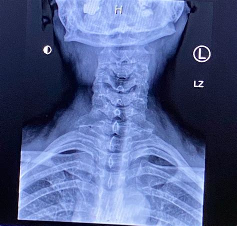 Bilateral Cervical Rib Is The Cervical Rib The Smaller Protrusion Up High Or Is It What Looks