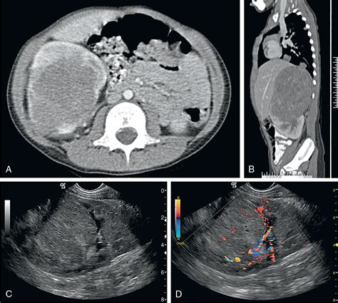 Solid Renal Lesions Radiology Key