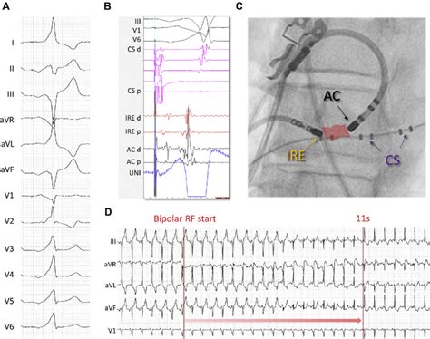 A A 12 Lead Electrocardiogram Of Preexcitation Recorded During Atrial Download Scientific