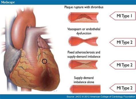 Plaque Formation Myocardial Infarction Nursing Care Plan Anatomy