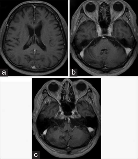 Isolated Neurosarcoidosis Presenting With Multiple Cranial Nerve