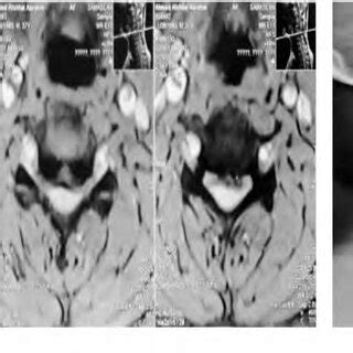 MRI Cervical Spine Sagittal A And Axial B Views Showing Multiple