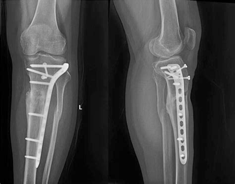 Postoperative Anteroposterior And Lateral Film Radiographs In 12 Months