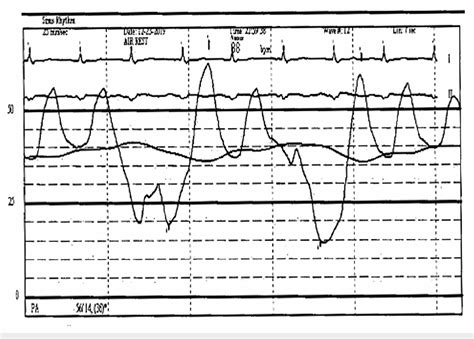 Figure From Acute Severe Mitral Regurgitation Secondary To Ischemic