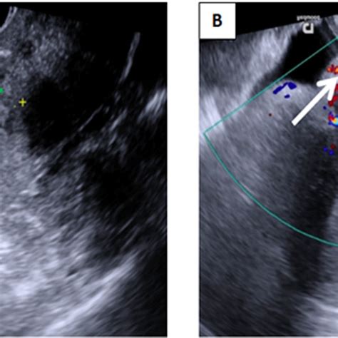 Transvaginal Ultrasound Image A Grayscale Sagittal Image Showing A