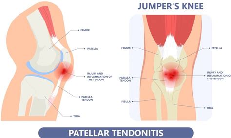 Jumpers Knee Causes Symptoms And Treatment Straits Podiatry