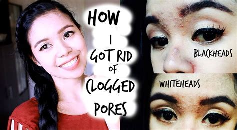 How I Got Rid Of My Clogged Pores Black Heads White Heads On Forehead And Nose Plus Skincare