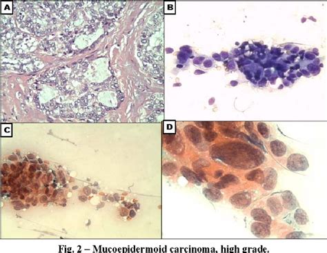 Figure 2 From Reliability Of Fine Needle Aspiration And Ex Tempore