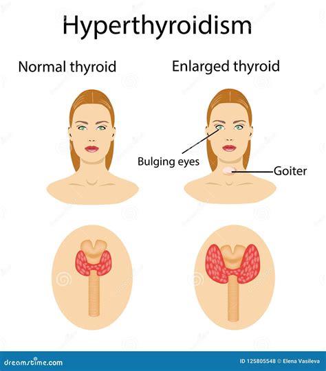 Woman With Enlarged Hyperthyroid Gland Vector Illustration Stock