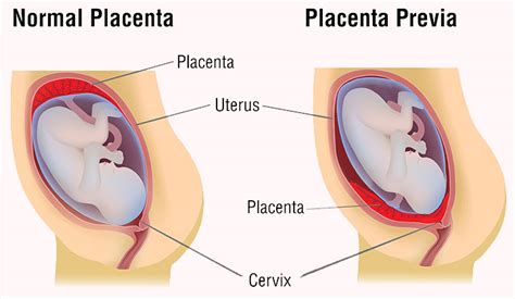 Placenta Previa Types Causes Symptoms And Treatment