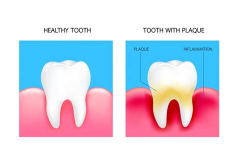 What Is Plaque And What Does It Look Like Dentek