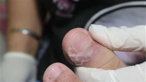 Ep3578 Ingrown Toenail Removal 👣 ยิ้มได้ล่ะออกมาแล้ว 😷 Clip From