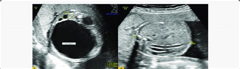 Prenatal Ultrasound Showing 1a Bilateral Hydronephrosis And