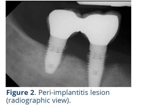 Dentalcare Ce680 Peri Implantitis Course User Guide