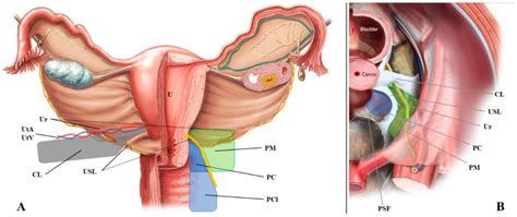 Ultrasound Of The Uterosacral Ligament Parametrium And Paracervix