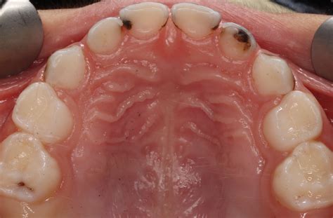 Clinical Cases | PDG Dental | Pediatric Dentistry & Orthodontics