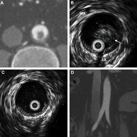 A Axial Computed Tomography Ct Image Showing Mural Aortic Thrombus 2 Download Scientific