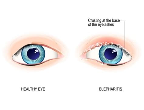 Blepharitis: Symptoms and Treatment | Fort Lauderdale Eye Institute