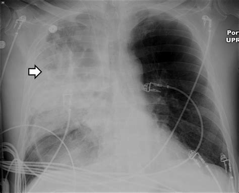 Lung Bullae With Air-Fluid Levels: What Is the Appropriate Therapeutic ...