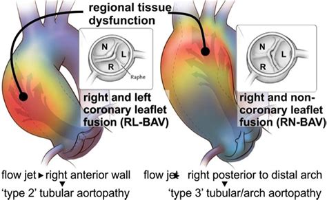 Frontiers Evolution Of Precision Medicine And Surgical Strategies For Bicuspid Aortic Valve