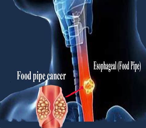 Esophageal Food Pipe Cancer Health Vision