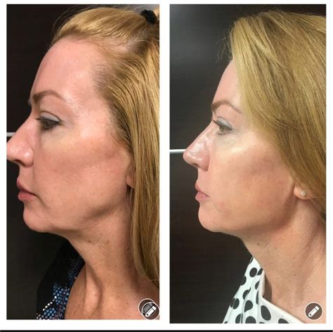 Fillers Before Afters Injectables In Collier County Beyond