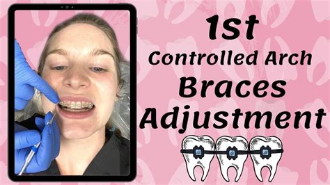 1st Braces Adjustment Controlled Arch Braces Youtube