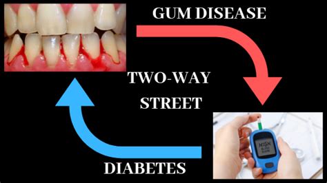 Diabetes And Oral Health A Two Way Link The Tooth Fairy Blog