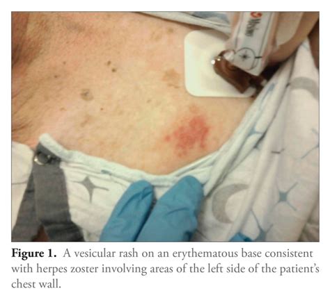 Disseminated Varicella Zoster Virus Infection With Encephalitis In A UC