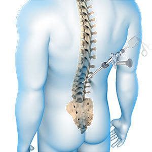 Endoscopic Spine Surgery Dallas TX | Spinal Fractures Dallas TX