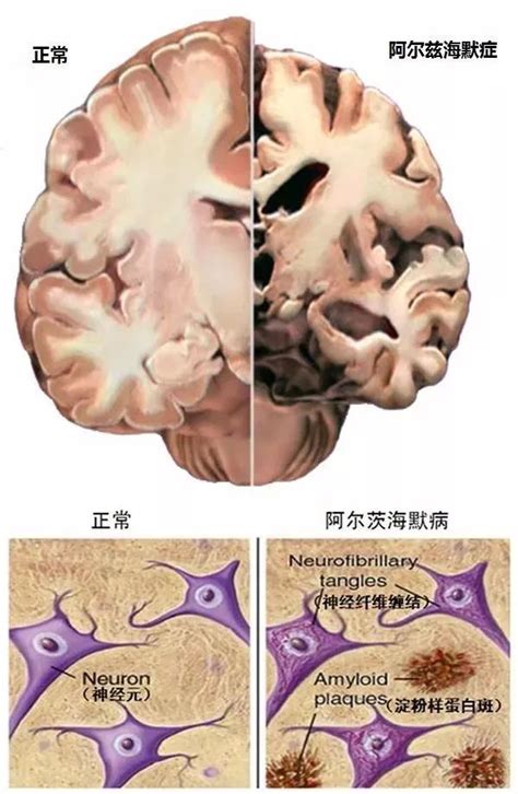 I Brainscience｜今天是中秋节，也是阿尔茨海默病日腾讯新闻