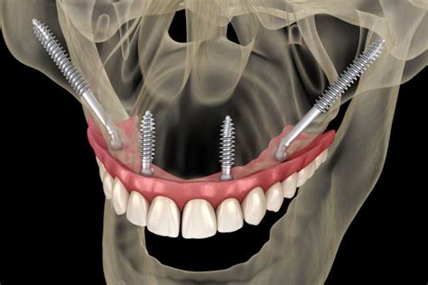 Zygomatic Implants San Antonio TX Preferred Dental Center