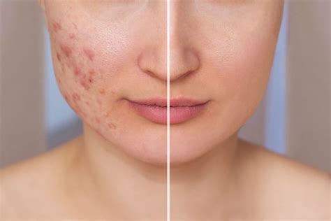 Efficient Ways To Get Rid Of Acne Scars Dermatology Clinic And Cosmetic