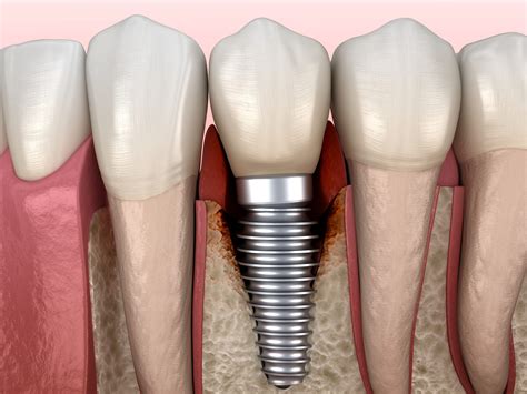 Qu Es La Periimplantitis Signos Y Tratamientos Ceodont