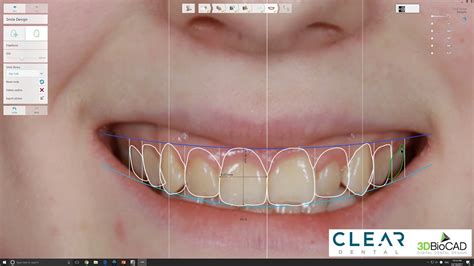 Mock Up Part 1 Digital Smile Design 3shape Trios Youtube