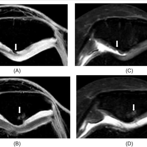 (PDF) Comparison of 2D Fat Suppressed Proton Density (FS-PD) and 3D (WATS-c) MRI pulse sequences ...