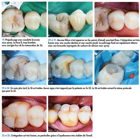 Mise En œuvre Clinique Dun Composite Universel De Dernière Génération