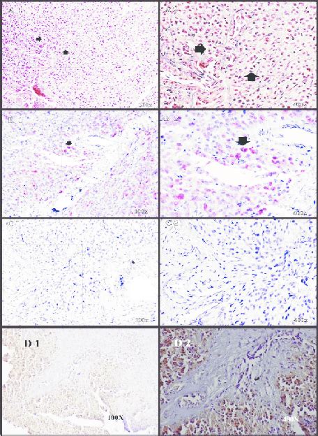 Ovary With A Leydig Cell Tumor Hande Staining Revealed Ovarian