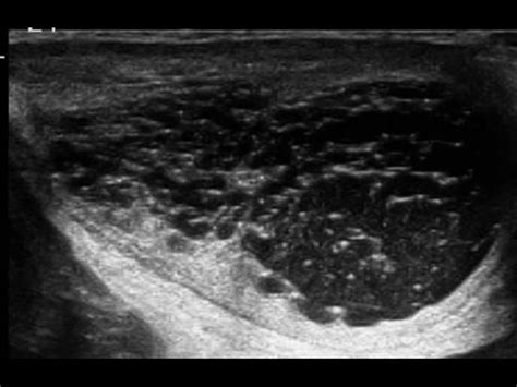 Rete Testis Ultrasound