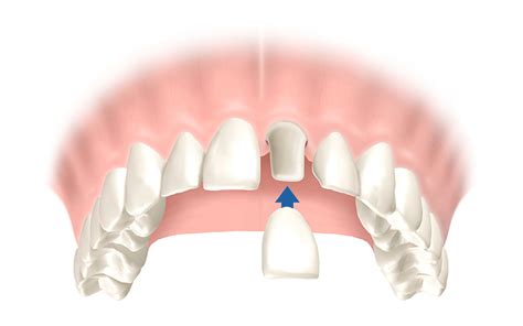 Wei E Z Hne Via Bleaching Kronen Br Cken Und Veneers