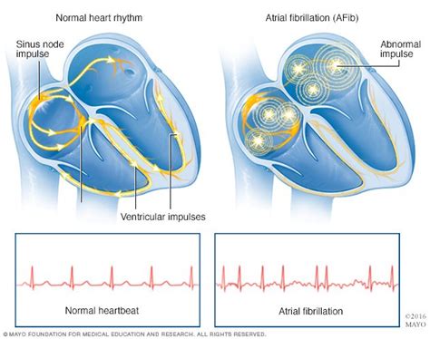 Atrial Fibrillation Disease Reference Guide Drugs