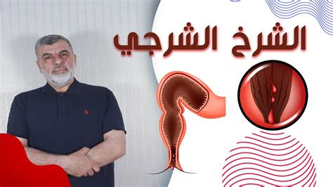 أسباب واعراض وعلاج الشق الشرجي بدون جراحة Youtube