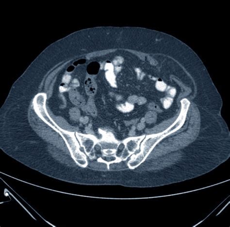 👉 Spigelian Hernia - Pictures, Symptoms, Location, Causes, Treatment (December 2021)