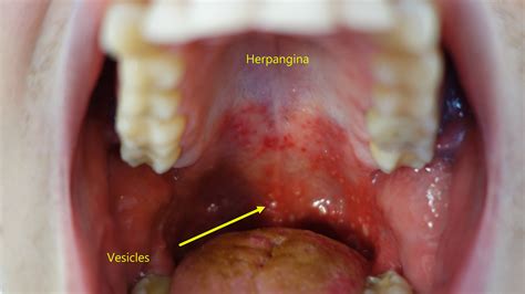 Hand Foot And Mouth Disease Differential Diagnosis Wikidoc