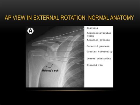 Radiographic Evaluation Of Shoulder