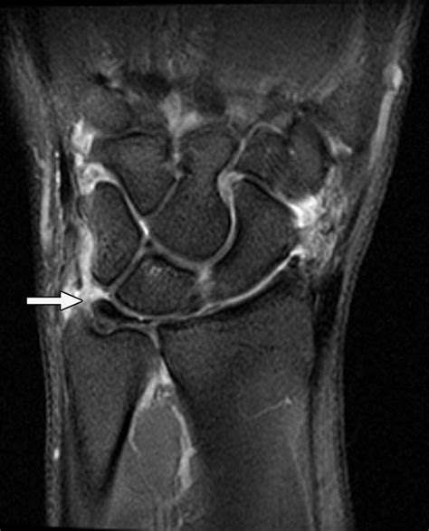 Comparison Of 3 T Mri And Arthroscopy Of Intrinsic Wrist Ligament And