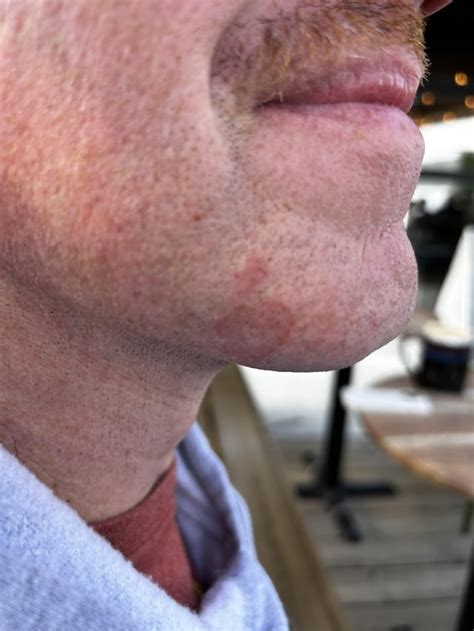 What Is This Rash Under My Husband’s Beard R Beards